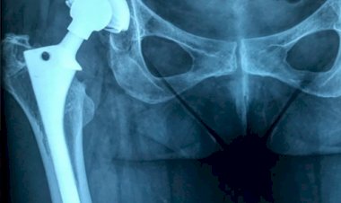 Governo de Rondônia amplia acesso a cirurgias de quadril com incentivo financeiro estadual